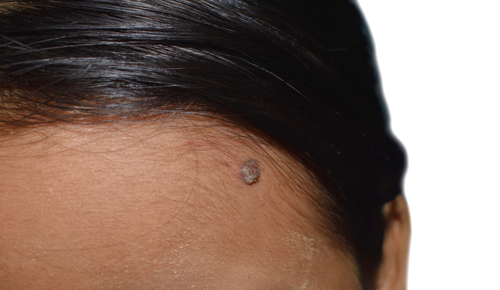 papilloma oms