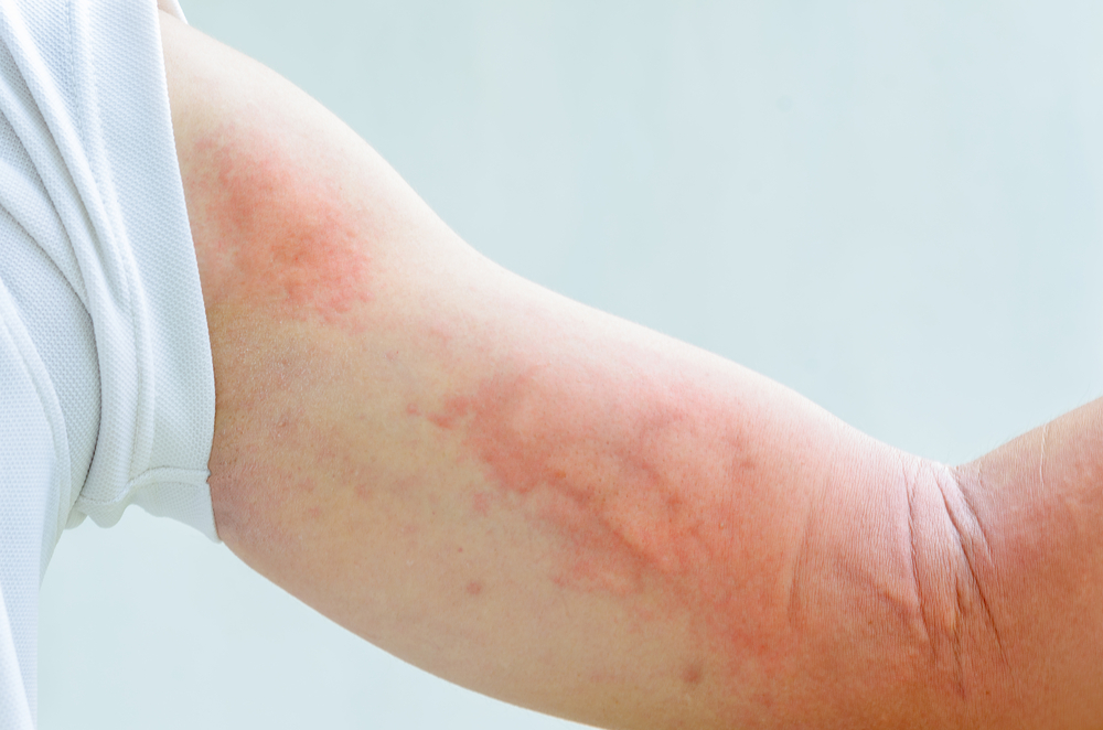 Аллергия на нервной почве - симптомы и лечение