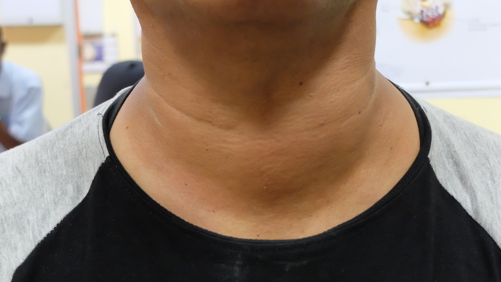 Зоб ахан. Увеличенная щитовидная железа.