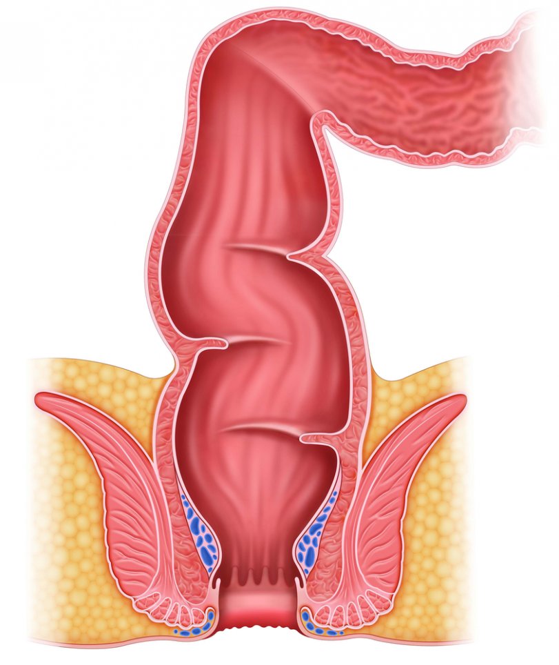 Анальные трещины